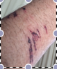 arm injury.png